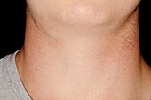 Swollen lymph gland in the neck