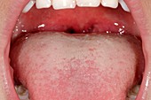 Coated tongue in respiratory infection