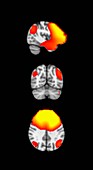 MEG Brain Scans