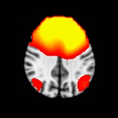 MEG Brain Scan