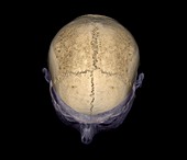 Skull sutures,3D CT scan