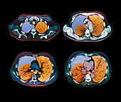 Pneumothorax,CT scan