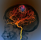 Brain vascular abnormality,3D CT scan