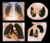 Kaposi's sarcoma of the lung,CT scans