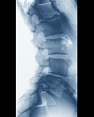 Scheuermann's disease,X-ray
