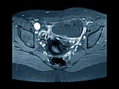 Ovarian cyst,X-ray
