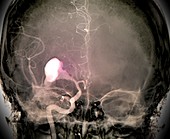 Brain haemorrhage,X-ray