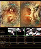 Internal heart anatomy,3D CT scan