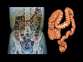 Healthy large intestine,X-ray & CT scan