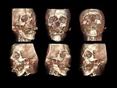 Traffic accident head injuries,CT scan