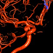 Brain aneurysm,3D X-ray