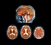 Marchiafava-Bignami disease,MRI scans