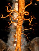 Abdominal aorta,3D CT scan
