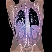 Haemopneumothorax,CT scan