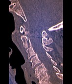 Spine fracture,CT scan