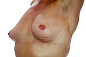 Breast cancer,surgical treatment