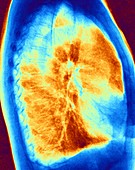 Normal chest coloured x-ray