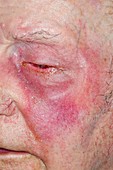 Cellulitis around the eye