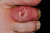 Infected toe ulcer