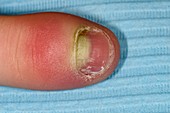 Paronychia infection of the thumb