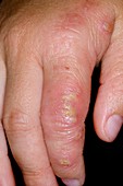 Infected eczema on the finger