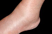 Ankle swelling after amlodipine drug