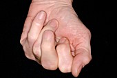 Osteoarthritis of the hand