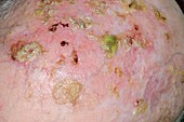 Skin cancer and keratoses on scalp