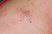 Metastatic melanoma skin cancer