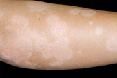 Lighter skin after psoriasis treatment