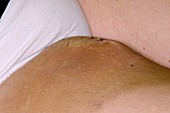 Bruising after skin cancer removal
