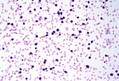 Acute lymphocytic leukaemia,micrograph