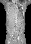 Pleural effusion in mesothelioma,X-ray