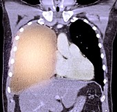 Pleural effusion in mesothelioma,CT scan