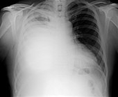 Pleural effusion in mesothelioma,X-ray