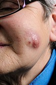 Abscess on the face