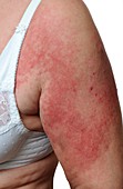 Skin rash in dermatomyositis