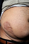 Keloid scar from kidney transplant