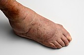 Rheumatoid arthritis of the foot