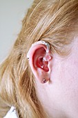 Hearing aid mould incorrectly fitted