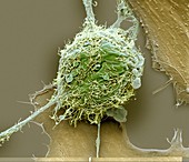 Bone cancer cell ,SEM