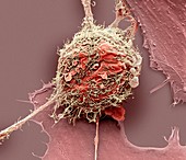Bone cancer cell ,SEM