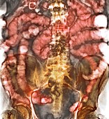 Small bowel obstruction,X-ray
