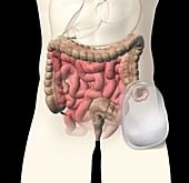Colostomy bag and intestines,artwork