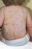 Chicken pox in a baby
