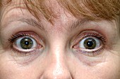 Dilated pupil in Holmes-Adie syndrome