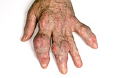 Gout in the fingers
