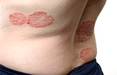 Plaques of psoriasis on the back