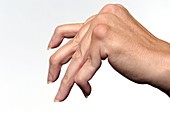 Rheumatoid arthritis of the fingers