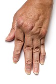 Rheumatoid arthritis of the fingers